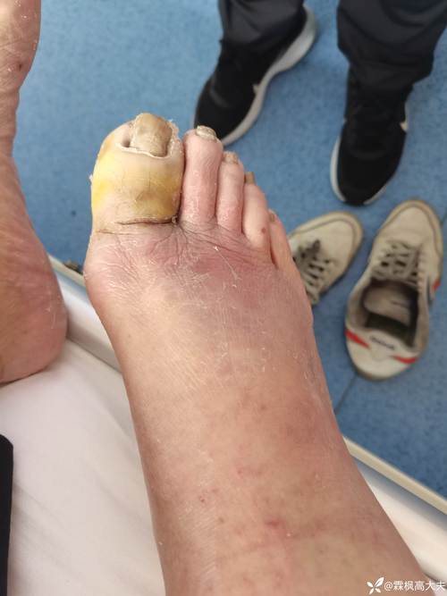 脚尾趾化脓痒痛是什么原因导致的「倒刺手指化脓挤出来以后多久消肿」 贵金属新闻